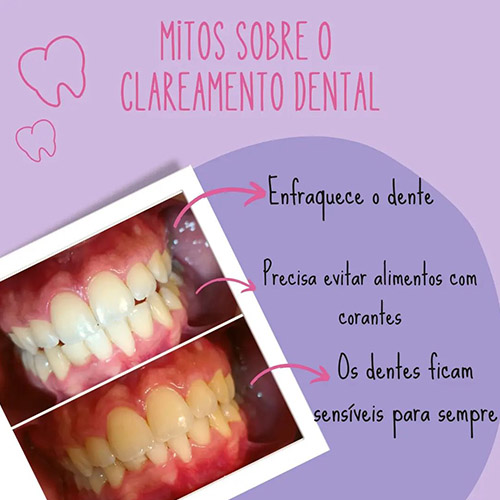 Mitos sobre o clareamento dental